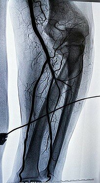 veins-03