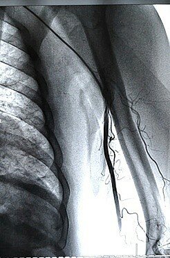 veins-02